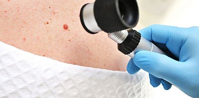 Ocena znamion skórnych – kiedy zmiana wymaga dalszego postępowania?