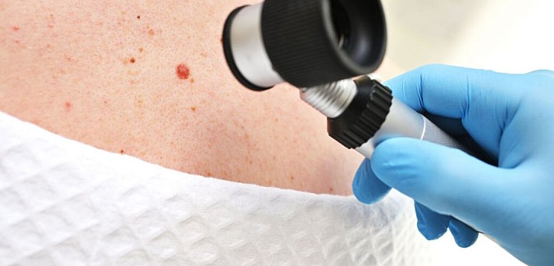 Ocena znamion skórnych – kiedy zmiana wymaga dalszego postępowania?