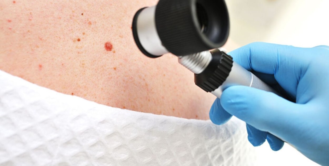 Ocena znamion skórnych – kiedy zmiana wymaga dalszego postępowania?